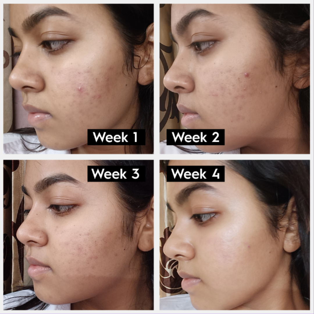 Bakuchiol Plumping Serum - Reduce Scars & Minimize Pores + Provide Even & brighten Skin