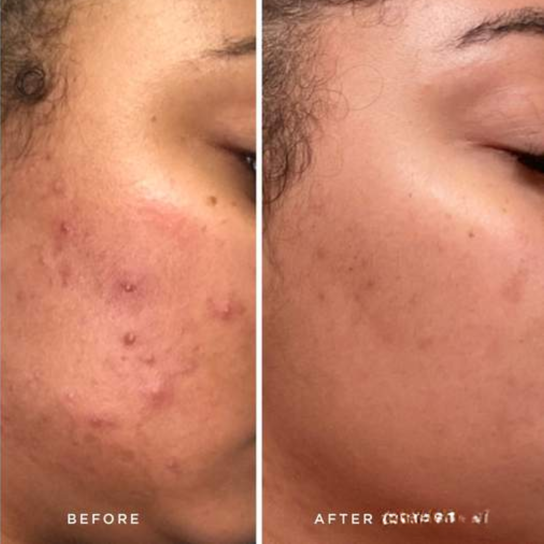 Bakuchiol Plumping Serum - Reduce Scars & Minimize Pores + Provide Even & brighten Skin