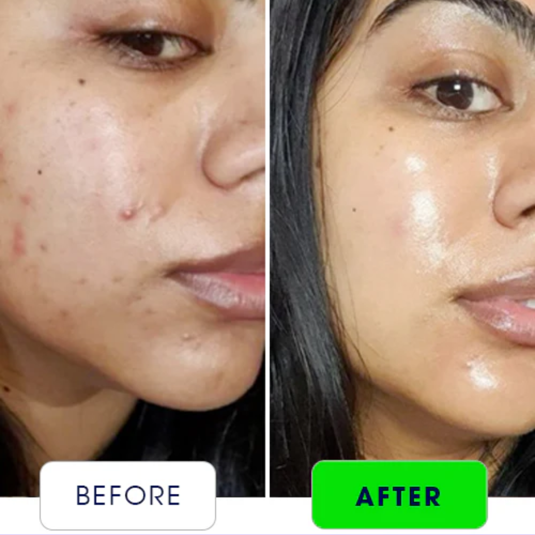 Bakuchiol Plumping Serum - Reduce Scars & Minimize Pores + Provide Even & brighten Skin