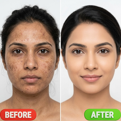 Amor SPOTLESS Clear Skin Anti-Acne Serum – Instant Radiance, Fades Acne Marks, Refines Pores, Reduces Breakouts
