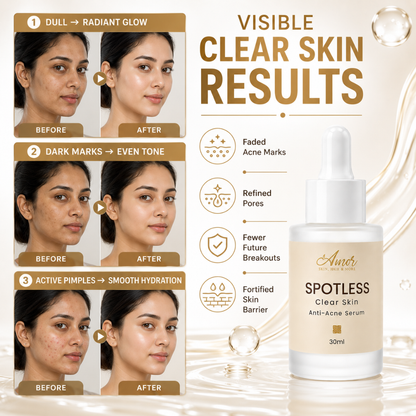 Amor SPOTLESS Clear Skin Anti-Acne Serum – Instant Radiance, Fades Acne Marks, Refines Pores, Reduces Breakouts